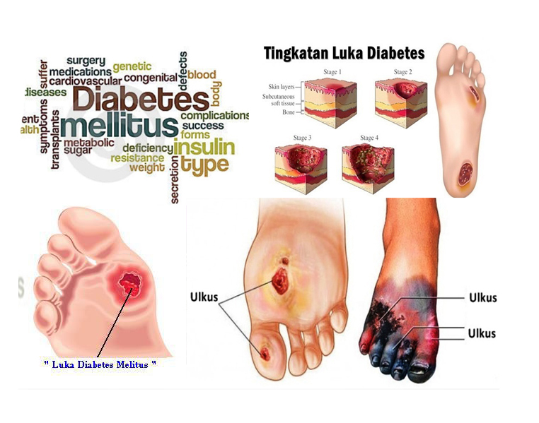 Okeman Obat Kencing Manis Diabetes-Melitus-8