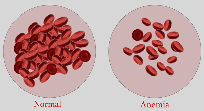 Cara alami mengobati anemia What is anemia