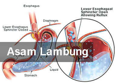 Jual Obat Asam Lambung Surabaya 