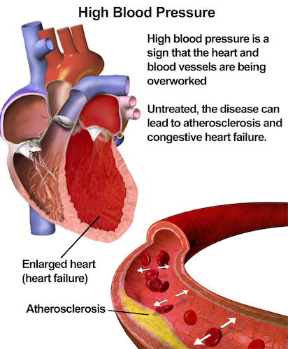 cara alami menurunkan tekanan darah tinggi faktor-penyebab darah tinggi
